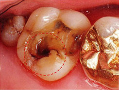 詰め物をはずしてみるとこんなにむし歯がひろがっていました