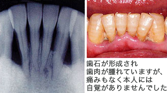 歯がぐらつくように感じて来院、歯を支える骨がなくなってきました